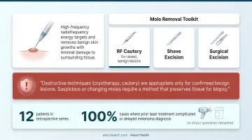 Four professional mole removal methods comparison chart shave excision to cryotherapy