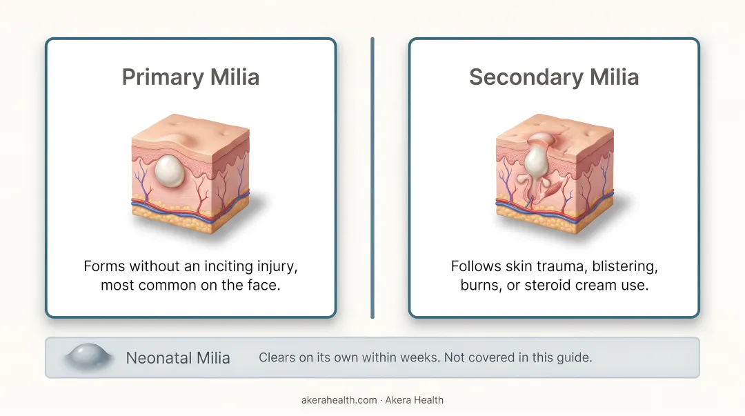 Three types of facial milia comparison chart primary secondary and neonatal