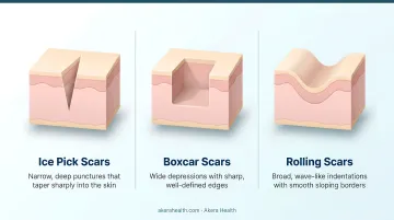 Three atrophic acne scar types ice pick boxcar rolling comparison infographic