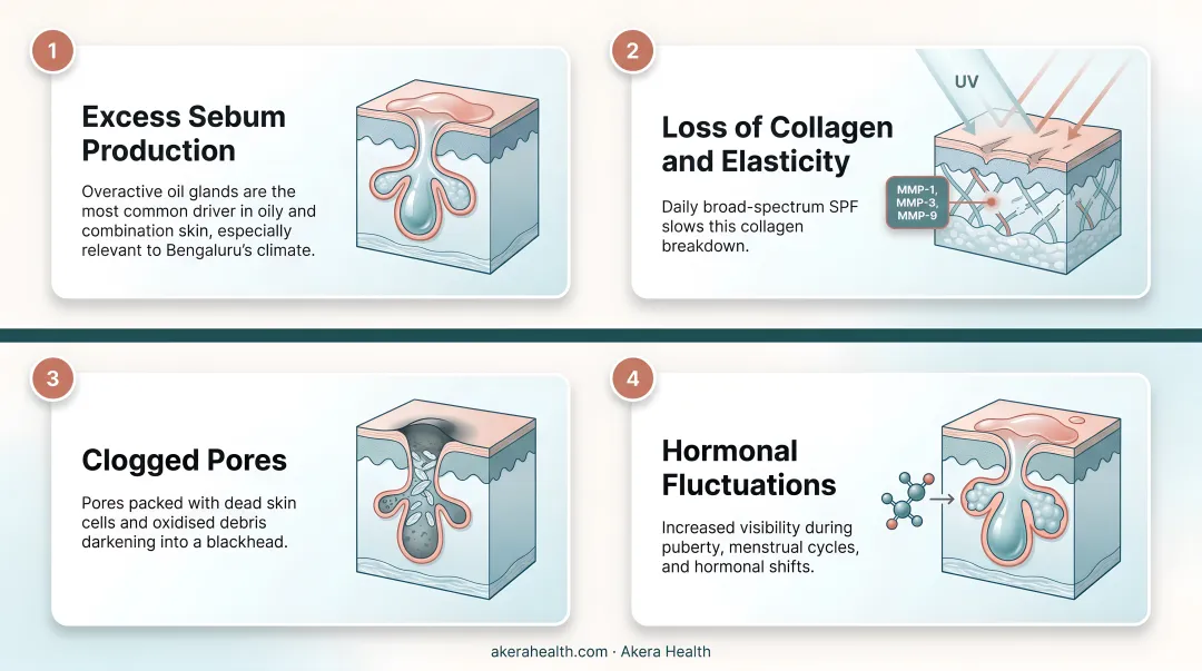 Four main causes of enlarged pores illustrated in skincare infographic