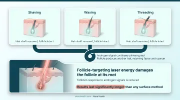 Surface hair removal versus laser follicle targeting method comparison infographic