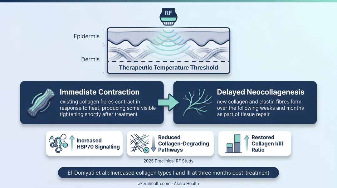 RF collagen remodelling two-stage timeline from immediate contraction to neocollagenesis