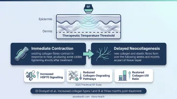 RF collagen remodelling two-stage timeline from immediate contraction to neocollagenesis