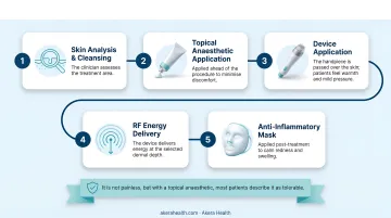 5-step RF microneedling treatment session protocol process flow infographic