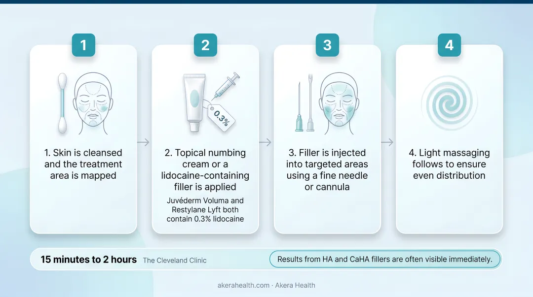 Four-step apple cheek filler injection session process flow diagram