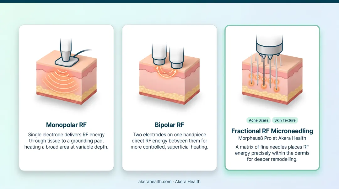 Three RF skin tightening delivery formats comparison chart monopolar bipolar fractional microneedling