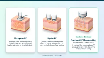 Three RF skin tightening delivery formats comparison chart monopolar bipolar fractional microneedling