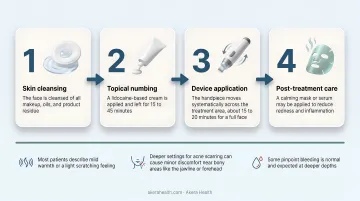 4-step professional microneedling procedure sequence from cleansing to post-treatment care