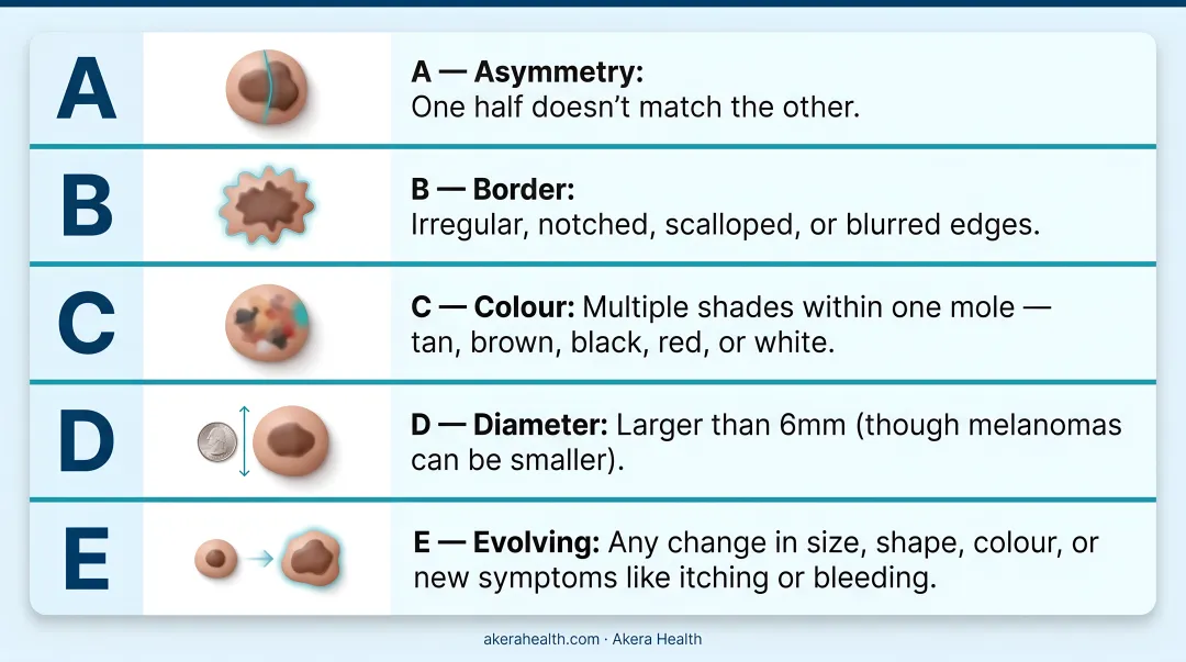 ABCDE rule for mole self-check five warning signs illustrated