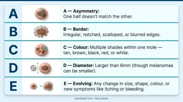 ABCDE rule for mole self-check five warning signs illustrated