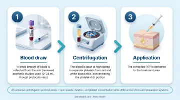 Three-step PRP preparation process blood draw centrifugation and application