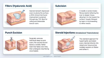 Four structural acne scar treatments fillers subcision punch excision steroid injections overview