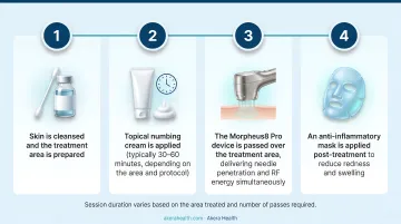 4-step RF microneedling in-clinic procedure from skin cleansing to post-treatment mask application