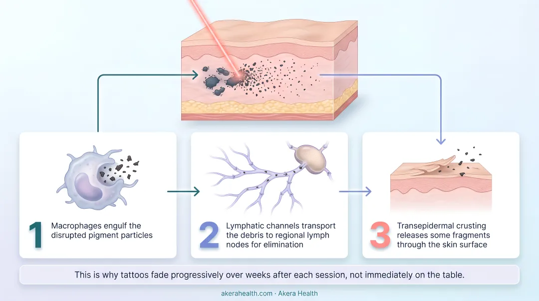 3-step tattoo ink clearance process after laser treatment infographic