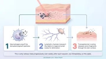 3-step tattoo ink clearance process after laser treatment infographic