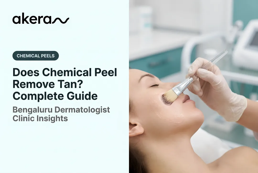 Does Chemical Peel Remove Tan? Complete Guide