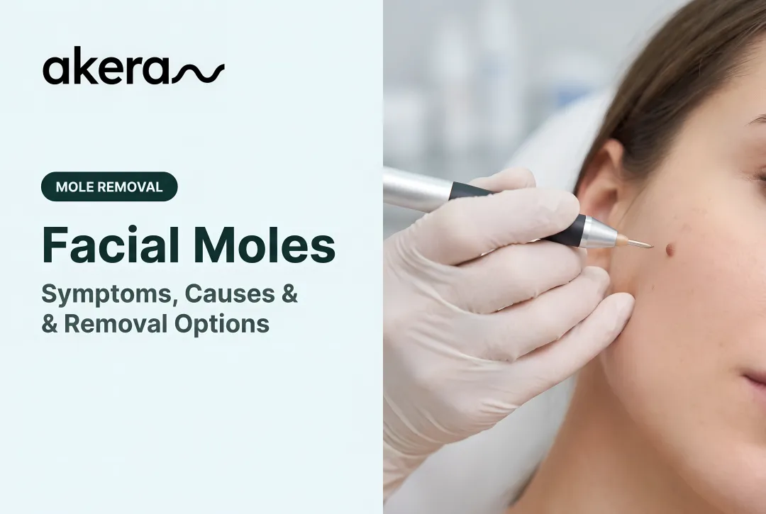 Facial Moles: Symptoms, Causes & Removal Options