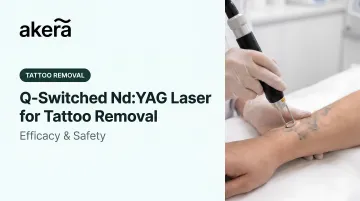 Q-Switched Nd:YAG Laser for Tattoo Removal: Efficacy &amp; Safety