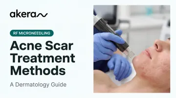 Acne Scar Treatment Methods: A Dermatology Guide