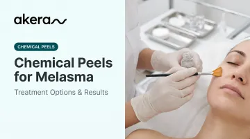 Chemical Peels for Melasma: Treatment Options &amp; Results