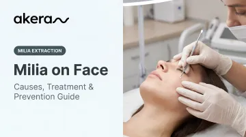 Milia on Face: Causes, Treatment &amp; Prevention Guide