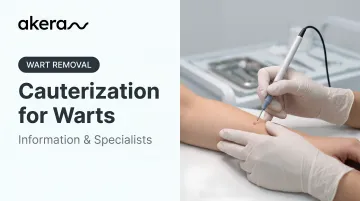 Cauterization for Warts: Information &amp; Specialists