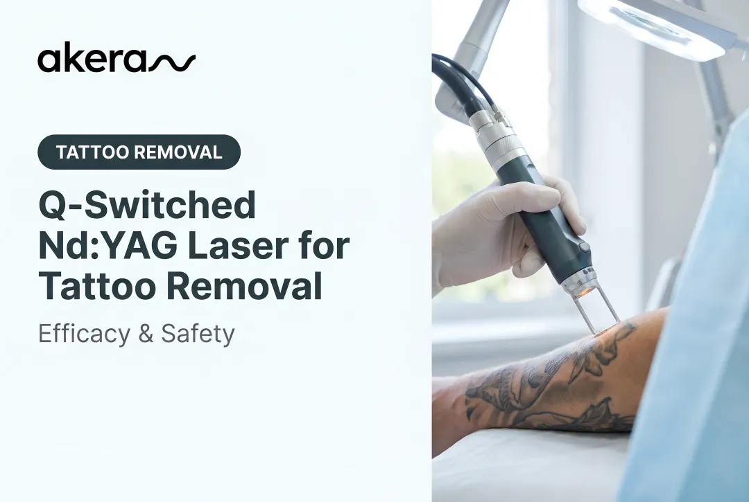 Q-Switched Nd:YAG Laser for Tattoo Removal: Efficacy & Safety