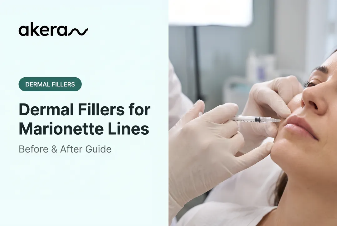 Dermal Fillers for Marionette Lines: Before & After Guide