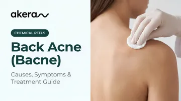 Back Acne (Bacne): Causes, Symptoms &amp; Treatment Guide