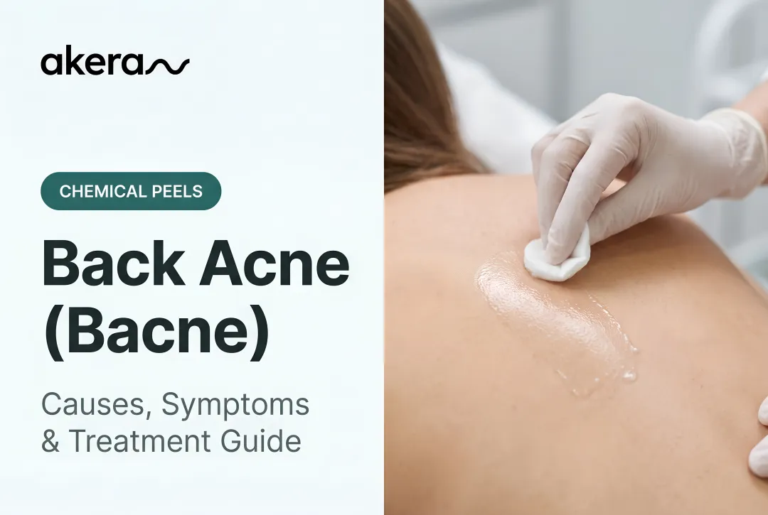 Back Acne (Bacne): Causes, Symptoms & Treatment Guide