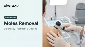 Moles Removal: Diagnosis, Treatment &amp; Options