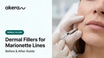 Dermal Fillers for Marionette Lines: Before &amp; After Guide