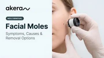 Facial Moles: Symptoms, Causes &amp; Removal Options