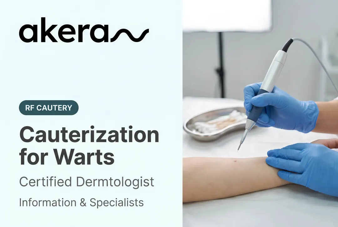 Cauterization for Warts: Information & Specialists