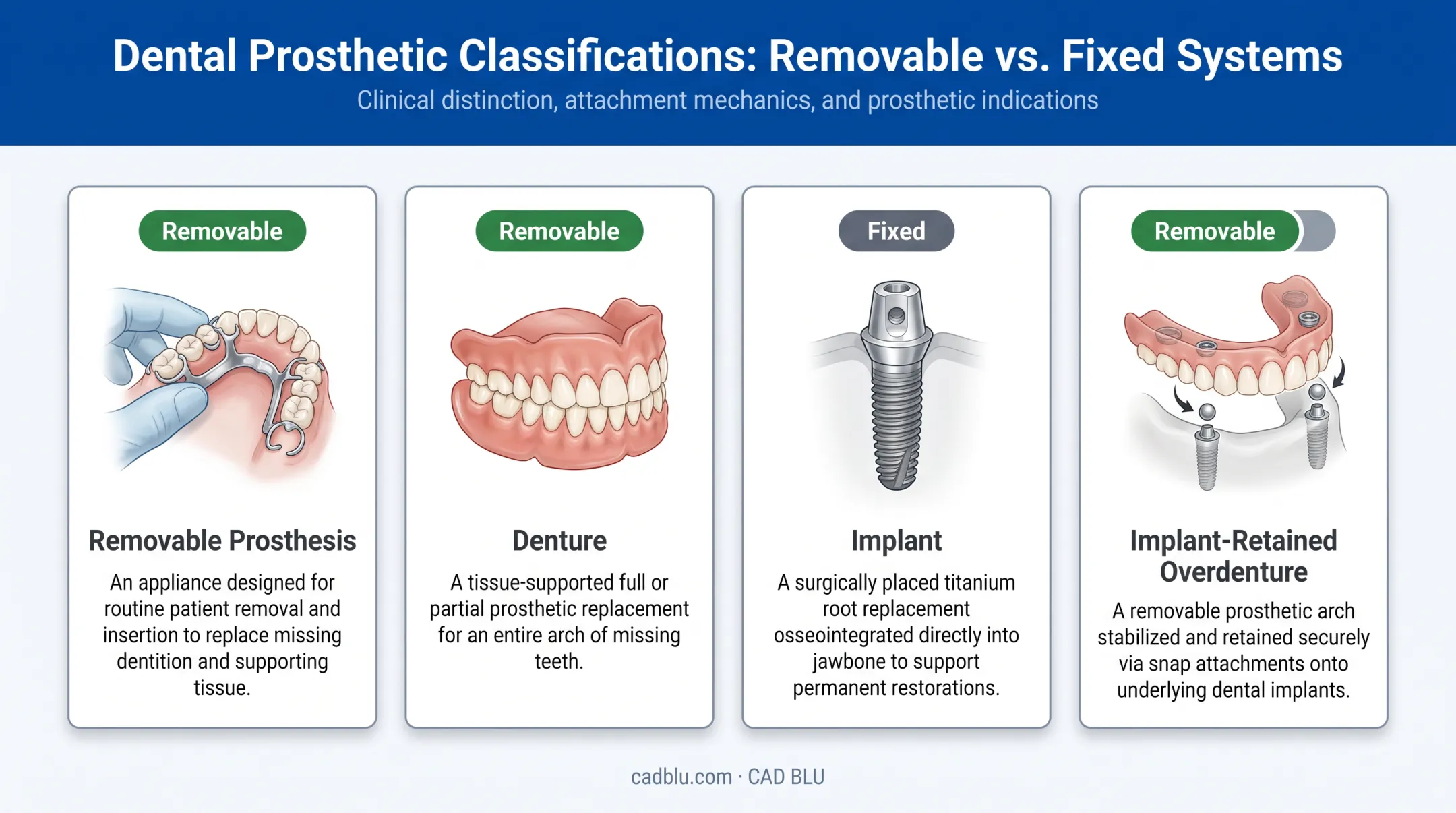 Comparison of removable prosthesis denture implant and overdenture definitions
