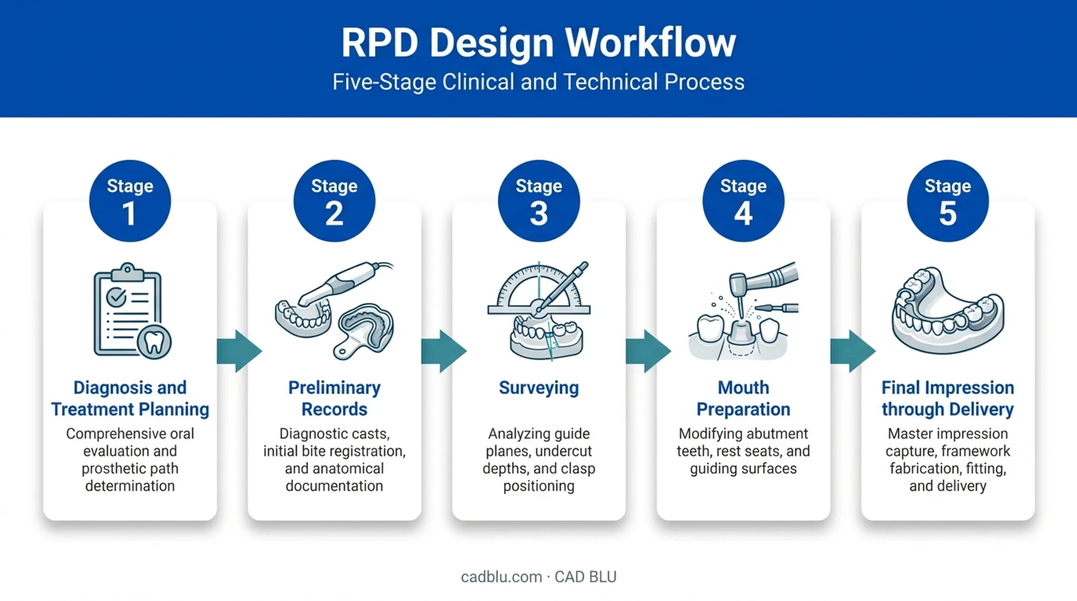 5-stage RPD design workflow from diagnosis to delivery