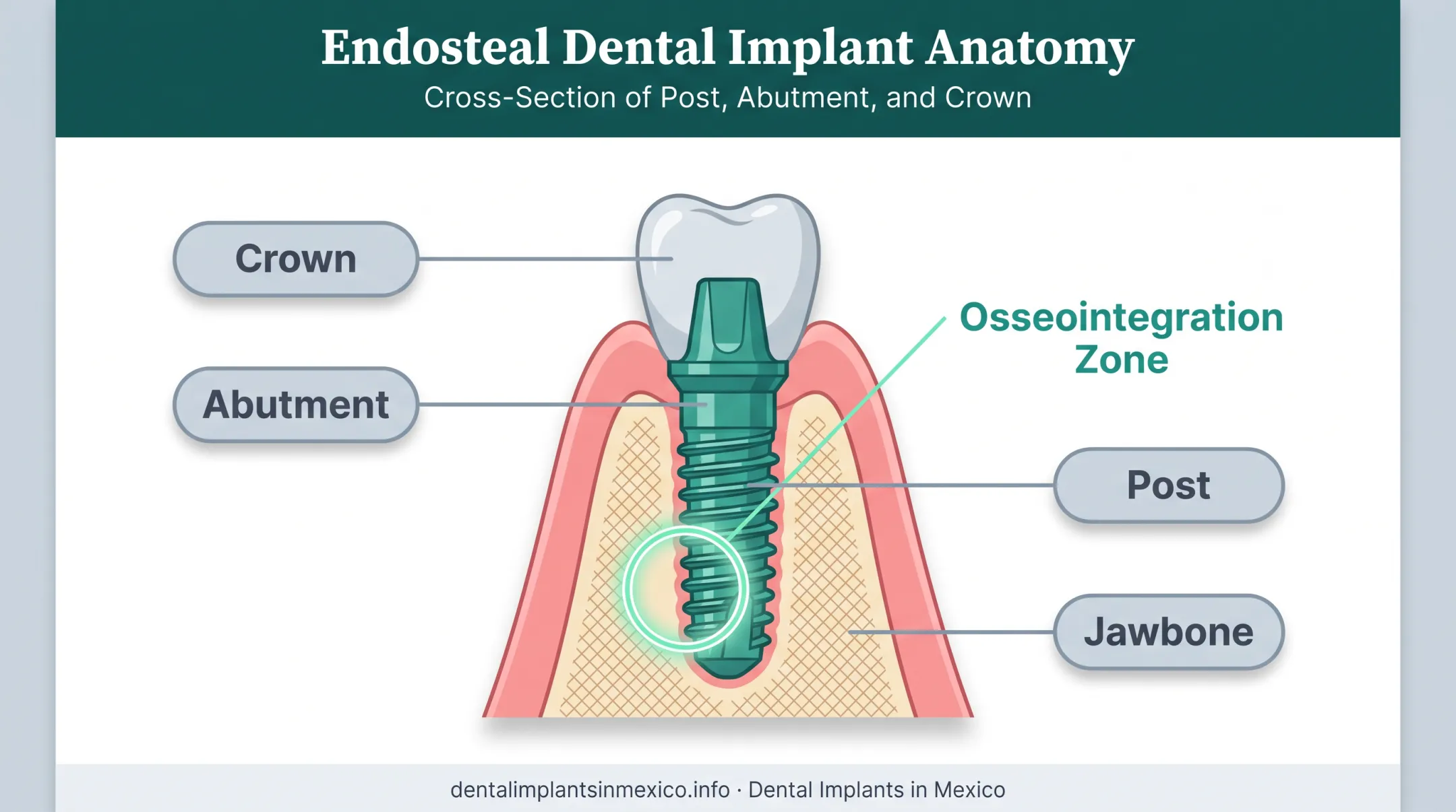 Endosteal implant placement diagram showing titanium post inside jawbone