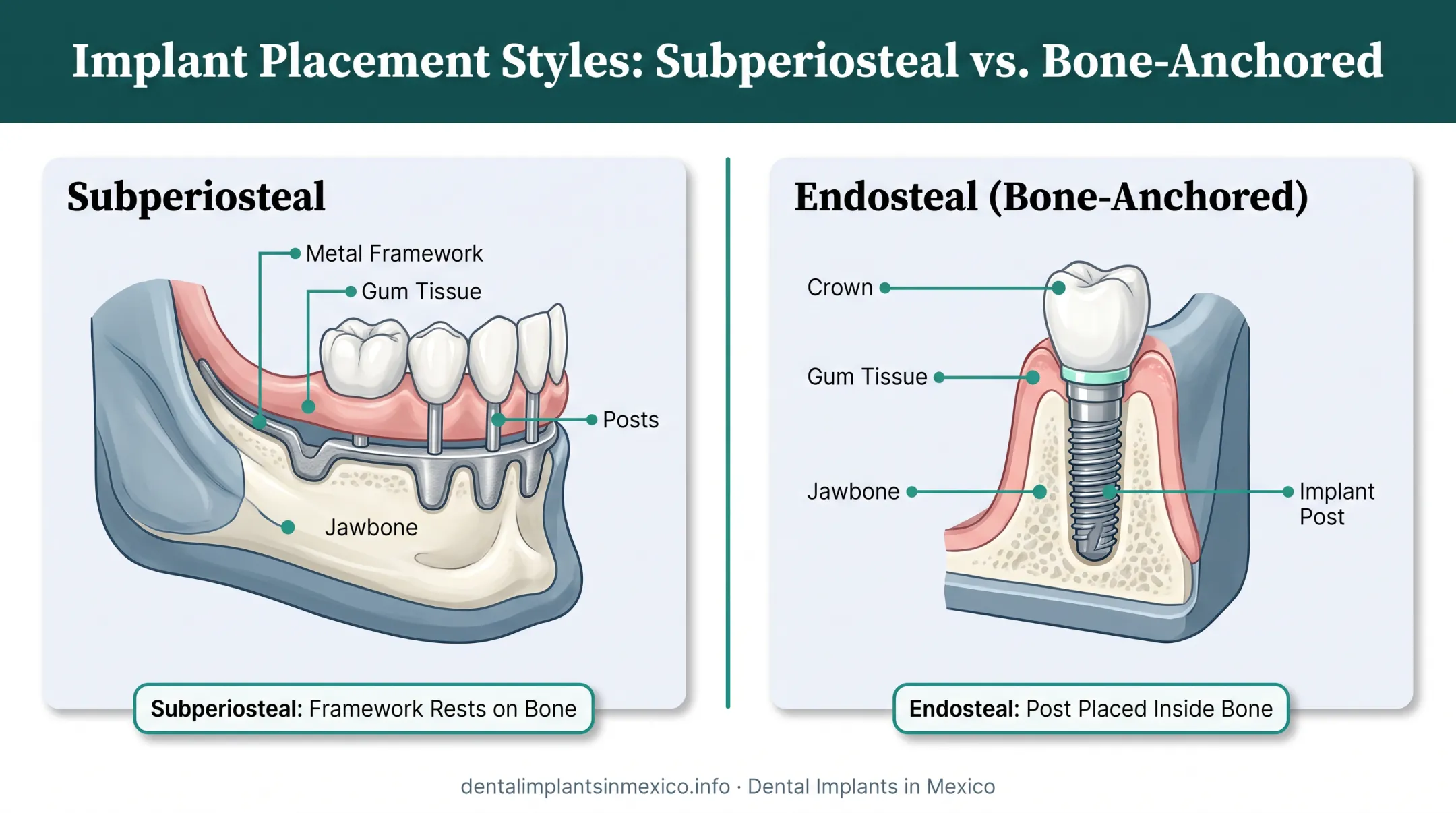 Subperiosteal implant framework resting on top of jawbone diagram