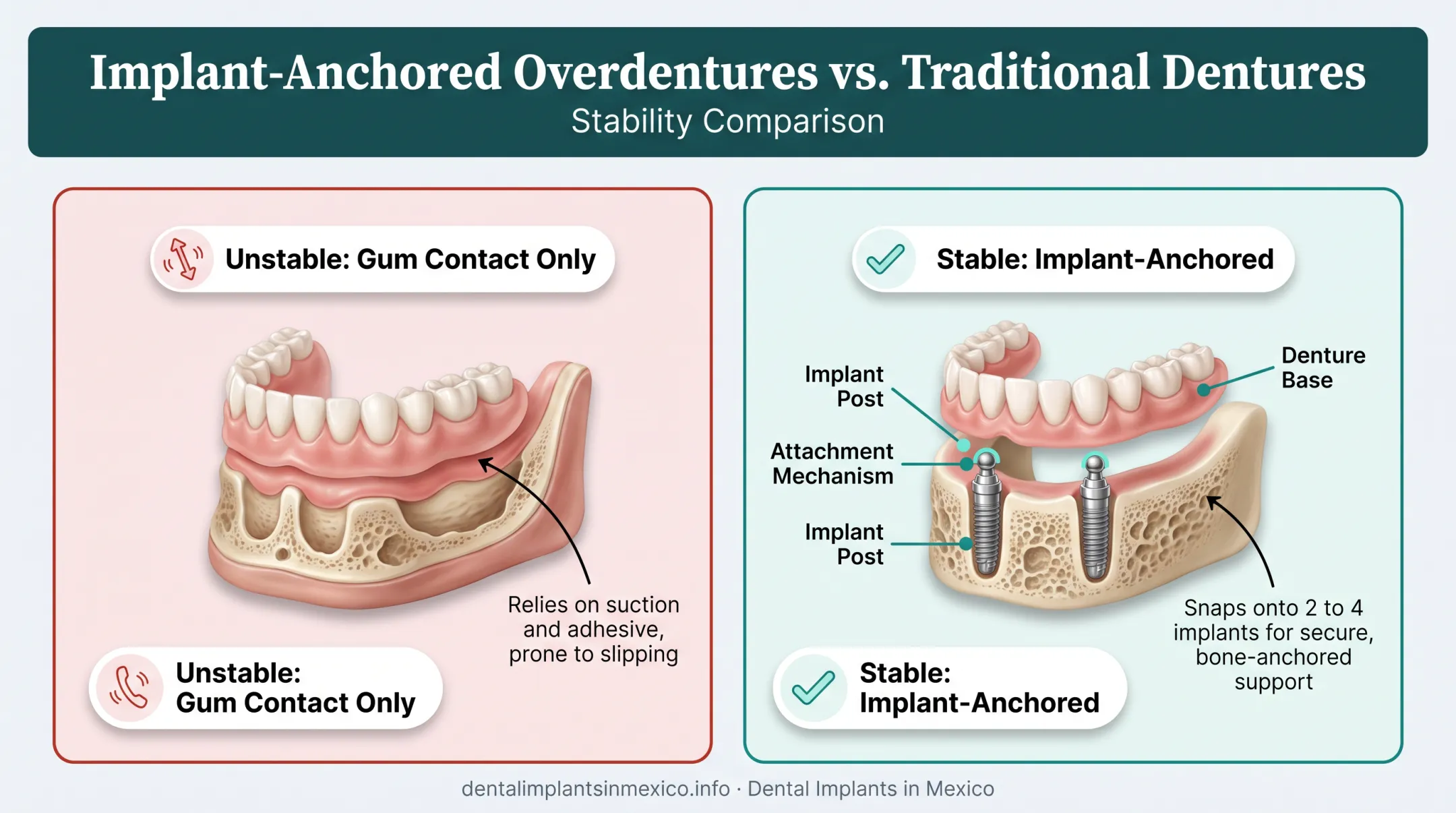 Snap-in overdenture attachment to implants diagram showing stability comparison