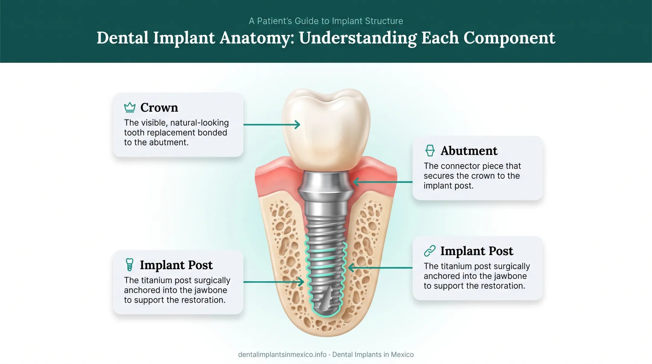 Single tooth implant cost breakdown showing post abutment and crown components