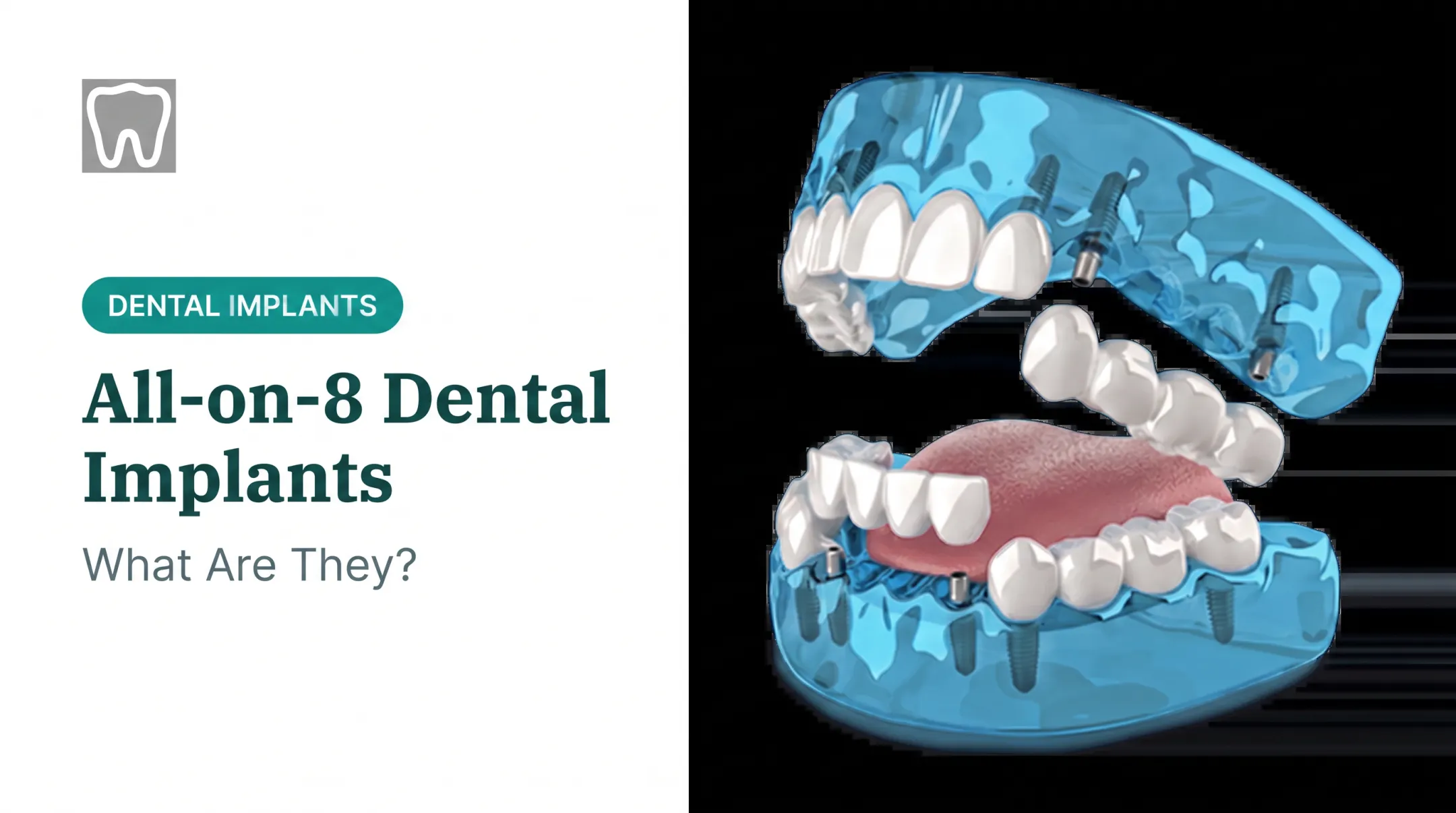 All-on-8 Dental Implants: What Are They?