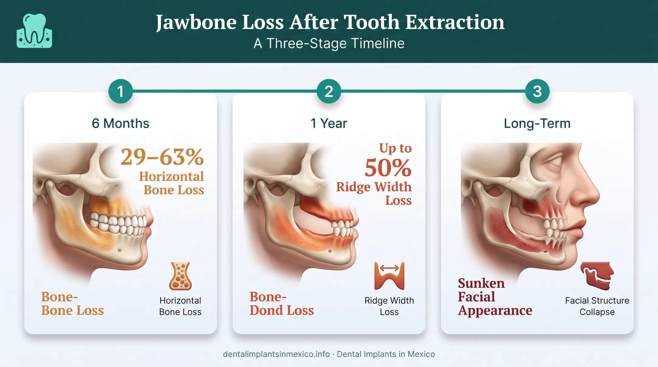 Jawbone loss timeline showing facial collapse after tooth extraction