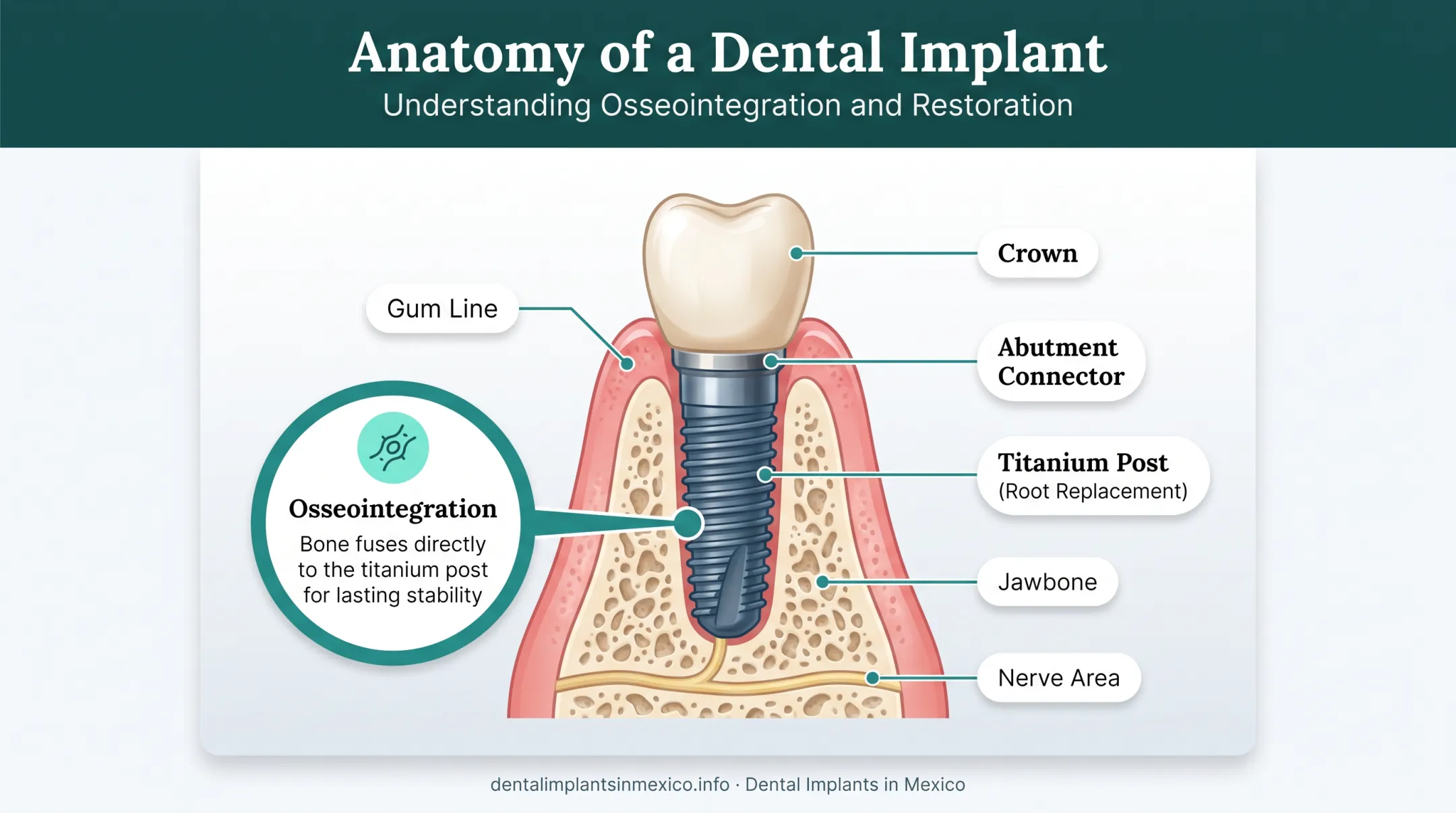 Dental implant anatomy showing titanium post crown and jawbone integration