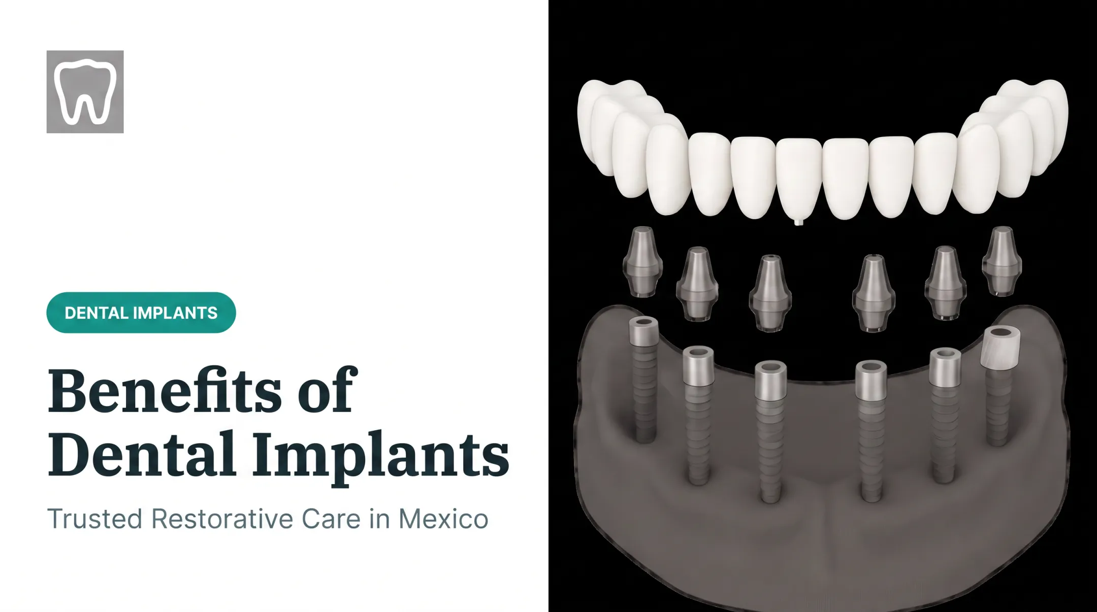 Benefits of Dental Implants