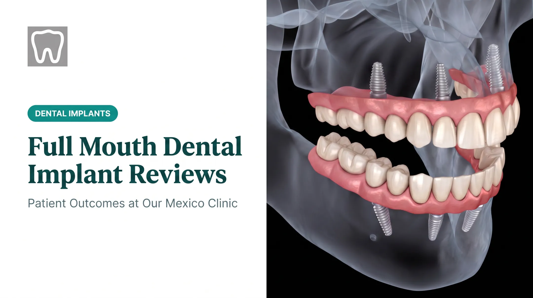 Full Mouth Dental Implant Reviews