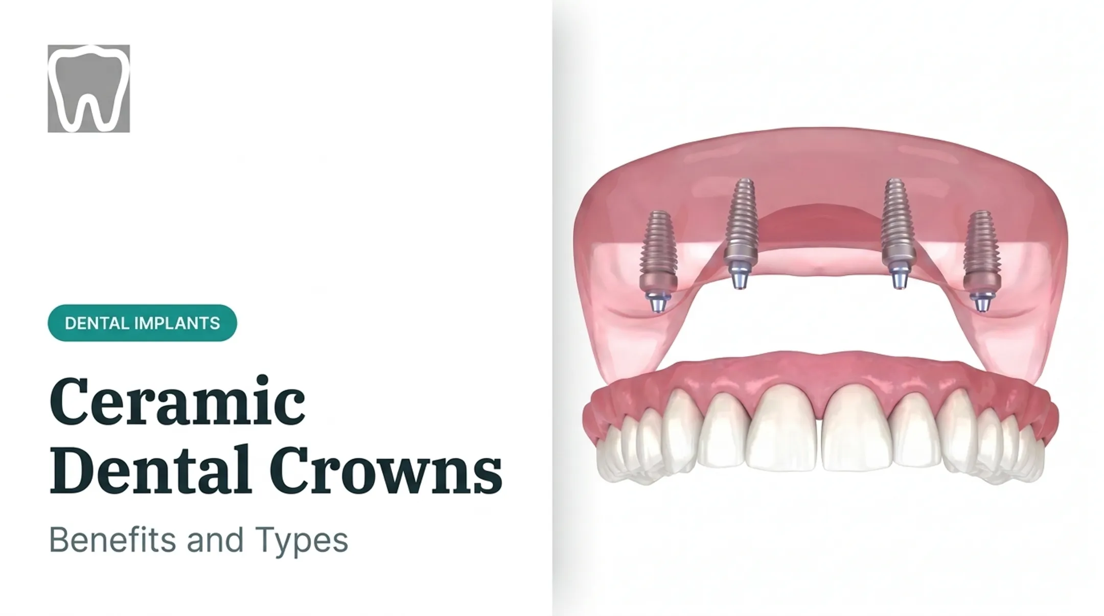 Ceramic Dental Crowns: Benefits and Types