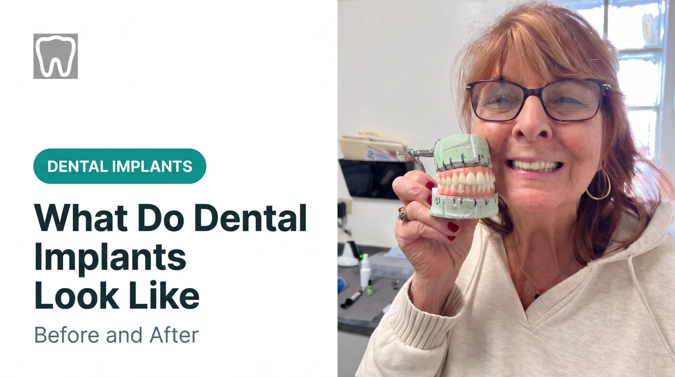 What Do Dental Implants Look Like: Before and After