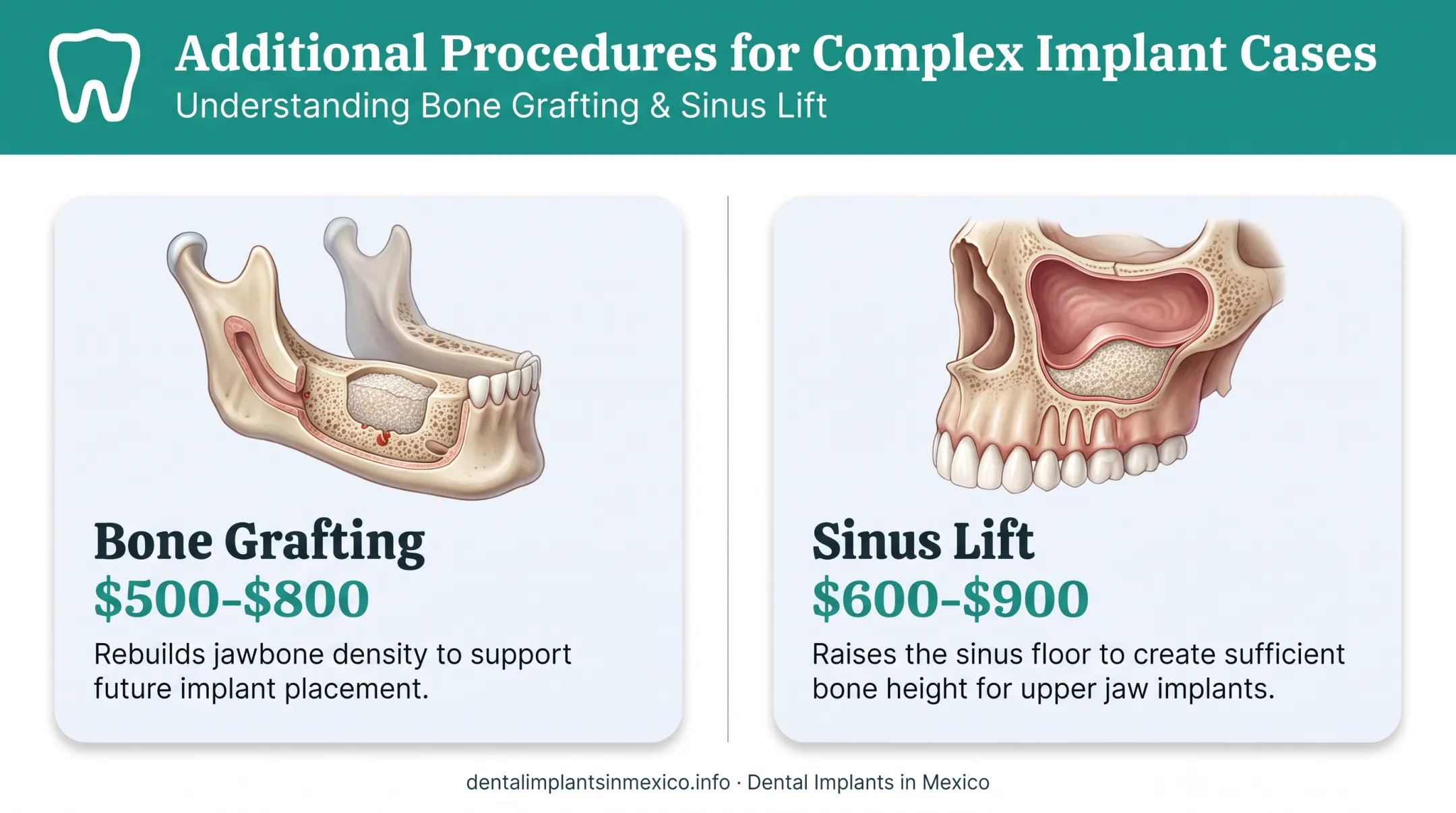 Bone grafting and sinus lift add-on costs for dental implant complexity