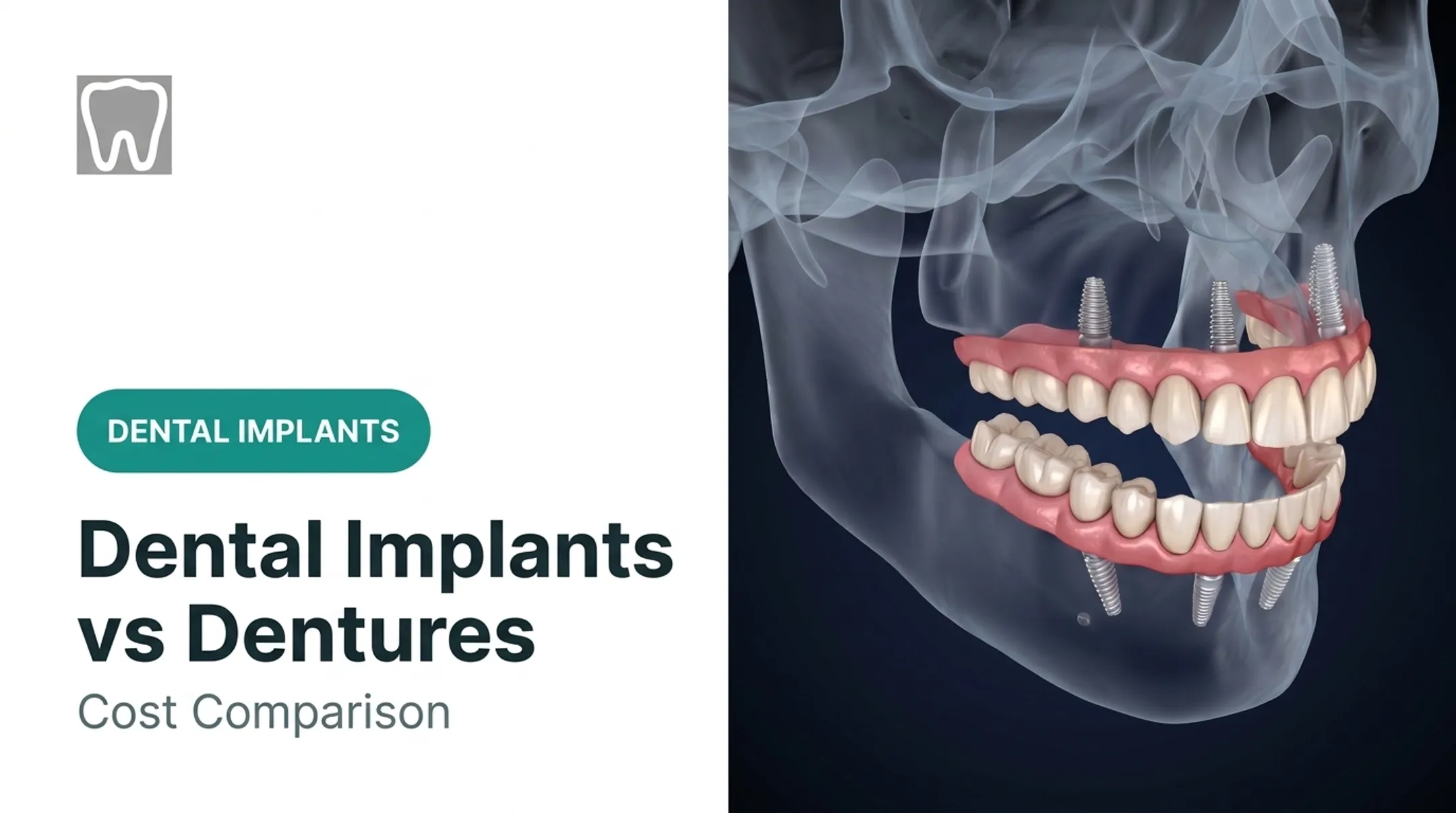 Dental Implants vs Dentures: Cost Comparison