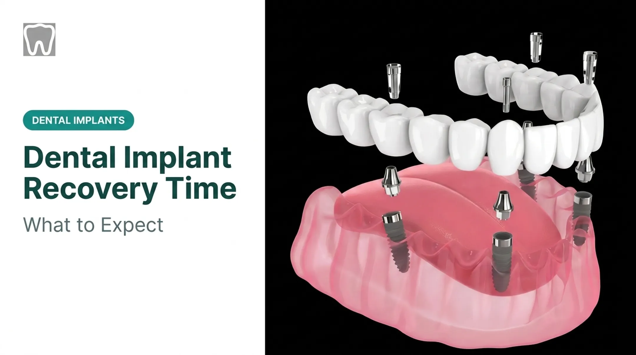Dental Implant Recovery Time: What to Expect